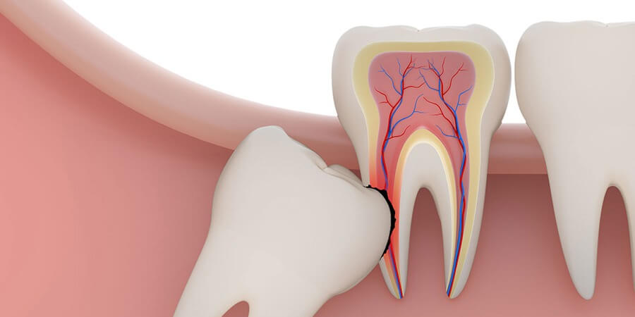 7 проблем зубов мудрости