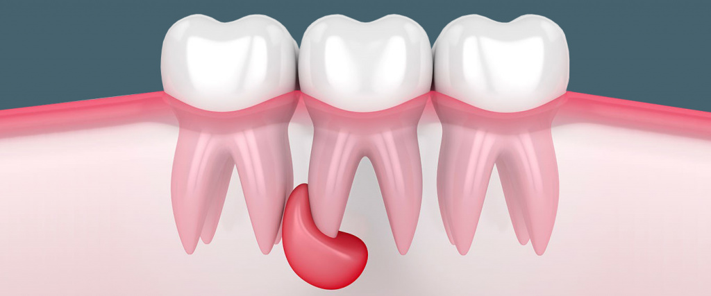 Почему может воспалиться лимфоузел после удаления зуба и что с этим делать